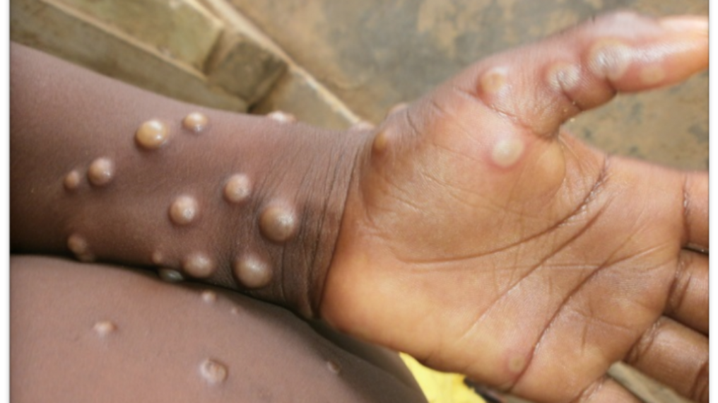 US CDC detects first case of monkeypox 'imported' from ...